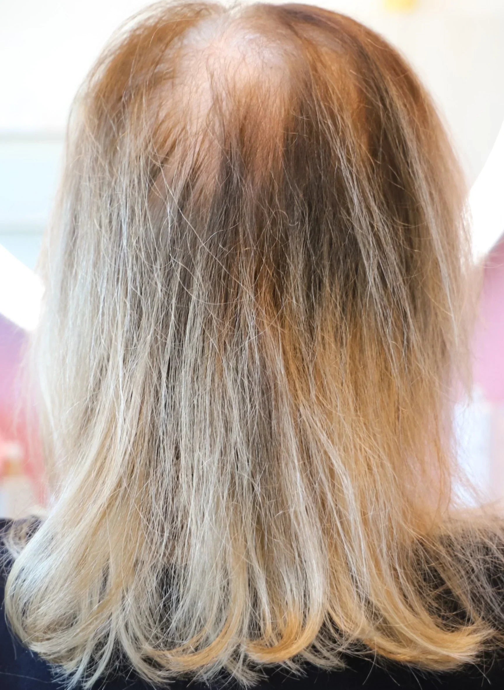 Before mesh integration hair transformation showing thin, fine hair at Delray Beach FL studio